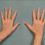 Fat Transfer Body Before & After Patient #9176