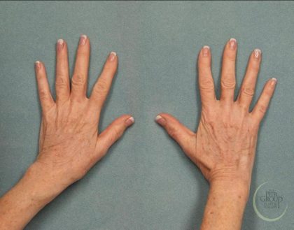 Fat Transfer Body Before & After Patient #9176