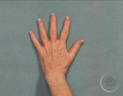 Fat Transfer Body Before & After Patient #9176