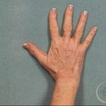 Fat Transfer Body Before & After Patient #9176