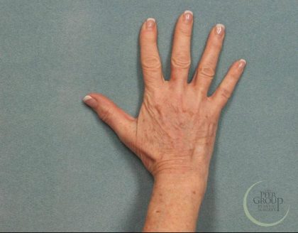 Fat Transfer Body Before & After Patient #9176