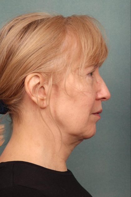 Fat Transfer Before & After Patient #9215