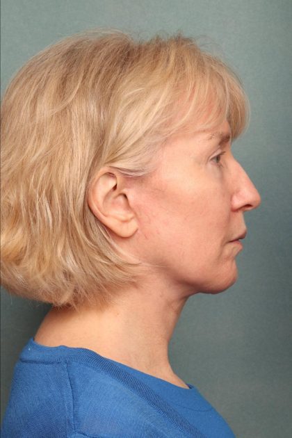 Fat Transfer Before & After Patient #9215