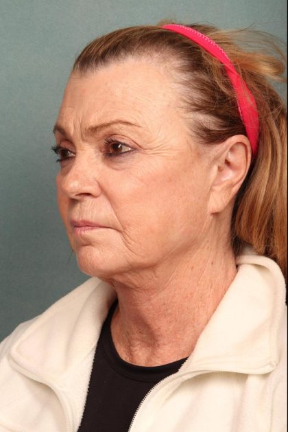 Fat Transfer Before & After Patient #9216