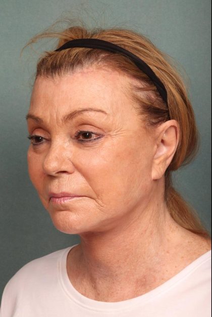 Fat Transfer Before & After Patient #9216