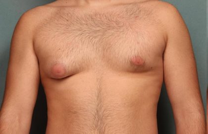 Gynecomastia Before & After Patient #9116
