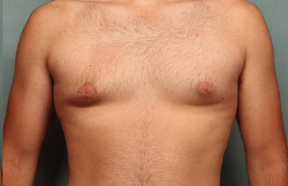 Gynecomastia Before & After Patient #9116