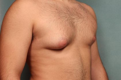 Gynecomastia Before & After Patient #9116