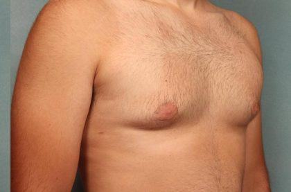 Gynecomastia Before & After Patient #9116
