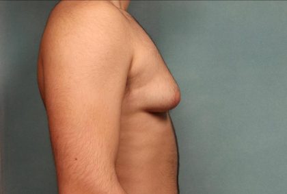Gynecomastia Before & After Patient #9116