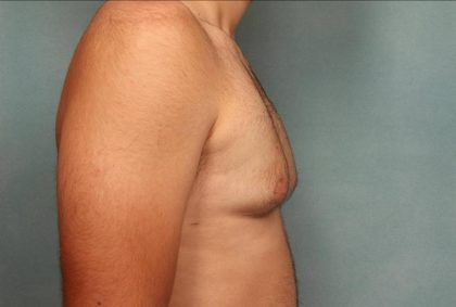 Gynecomastia Before & After Patient #9116