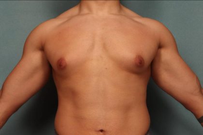 Gynecomastia Before & After Patient #9117