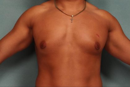 Gynecomastia Before & After Patient #9117