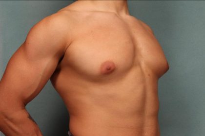 Gynecomastia Before & After Patient #9117