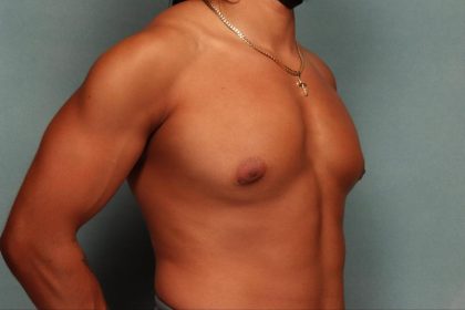 Gynecomastia Before & After Patient #9117