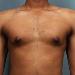 Gynecomastia Before & After Patient #9119