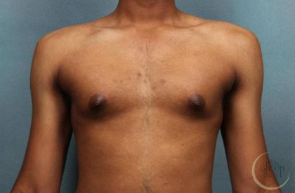 Gynecomastia Before & After Patient #9119