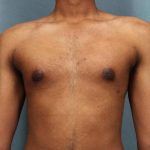 Gynecomastia Before & After Patient #9119