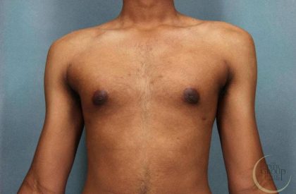 Gynecomastia Before & After Patient #9119