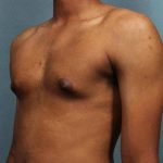 Gynecomastia Before & After Patient #9119