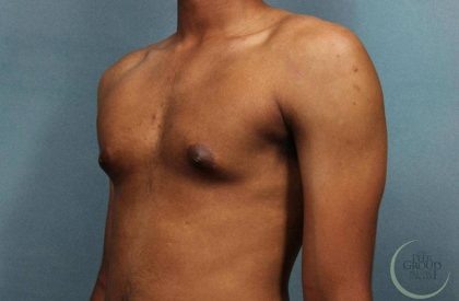 Gynecomastia Before & After Patient #9119