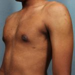 Gynecomastia Before & After Patient #9119