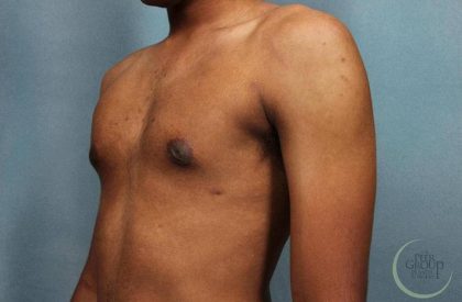 Gynecomastia Before & After Patient #9119