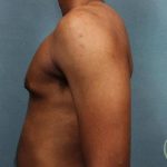 Gynecomastia Before & After Patient #9119