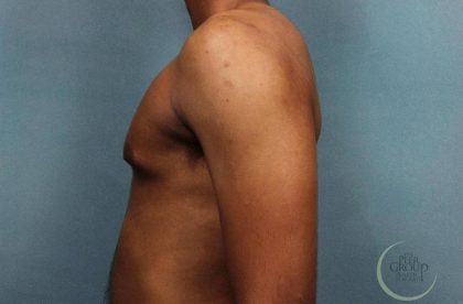 Gynecomastia Before & After Patient #9119