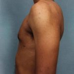 Gynecomastia Before & After Patient #9119