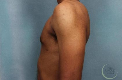 Gynecomastia Before & After Patient #9119