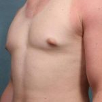 Gynecomastia Before & After Patient #9120