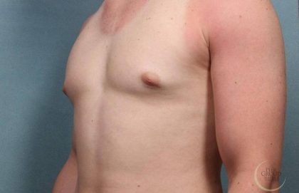 Gynecomastia Before & After Patient #9120