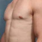 Gynecomastia Before & After Patient #9120