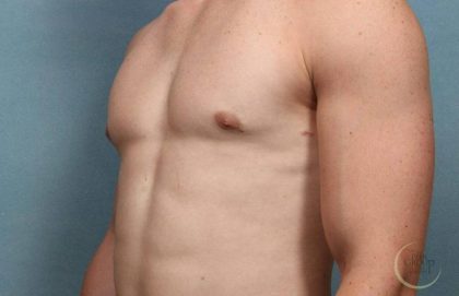 Gynecomastia Before & After Patient #9120