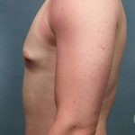 Gynecomastia Before & After Patient #9120