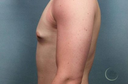Gynecomastia Before & After Patient #9120