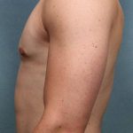 Gynecomastia Before & After Patient #9120