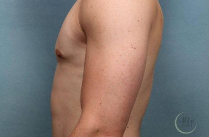 Gynecomastia Before & After Patient #9120