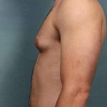 Gynecomastia Before & After Patient #9121