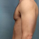 Gynecomastia Before & After Patient #9121