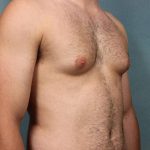 Gynecomastia Before & After Patient #9121