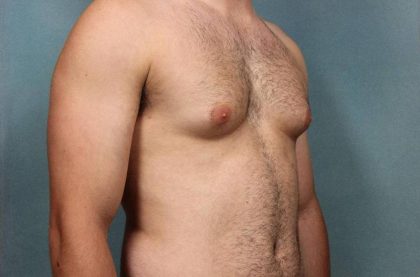 Gynecomastia Before & After Patient #9121