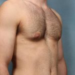 Gynecomastia Before & After Patient #9121
