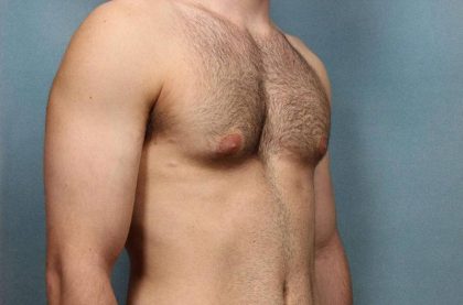 Gynecomastia Before & After Patient #9121