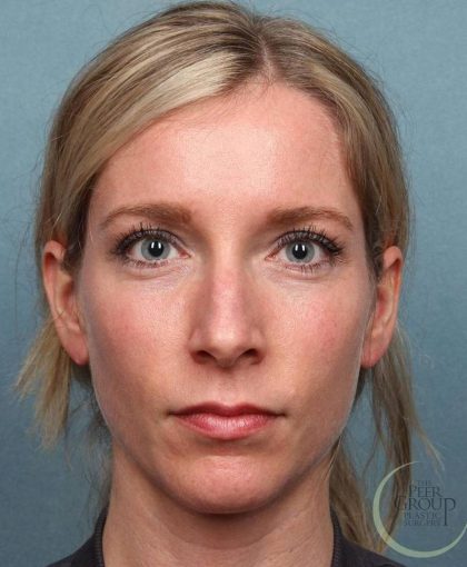Juvederm Vollure Before & After Patient #9073