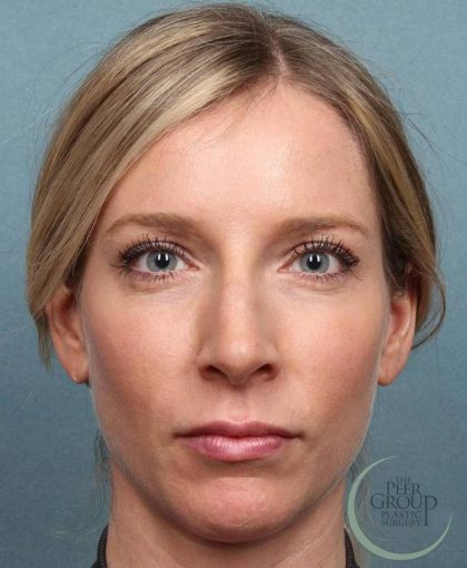 Juvederm Vollure Before & After Patient #9073