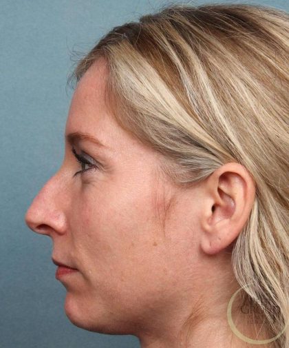Juvederm Vollure Before & After Patient #9073