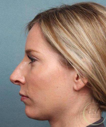 Juvederm Vollure Before & After Patient #9073
