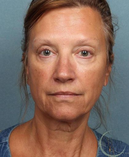 Juvederm Vollure Before & After Patient #9074